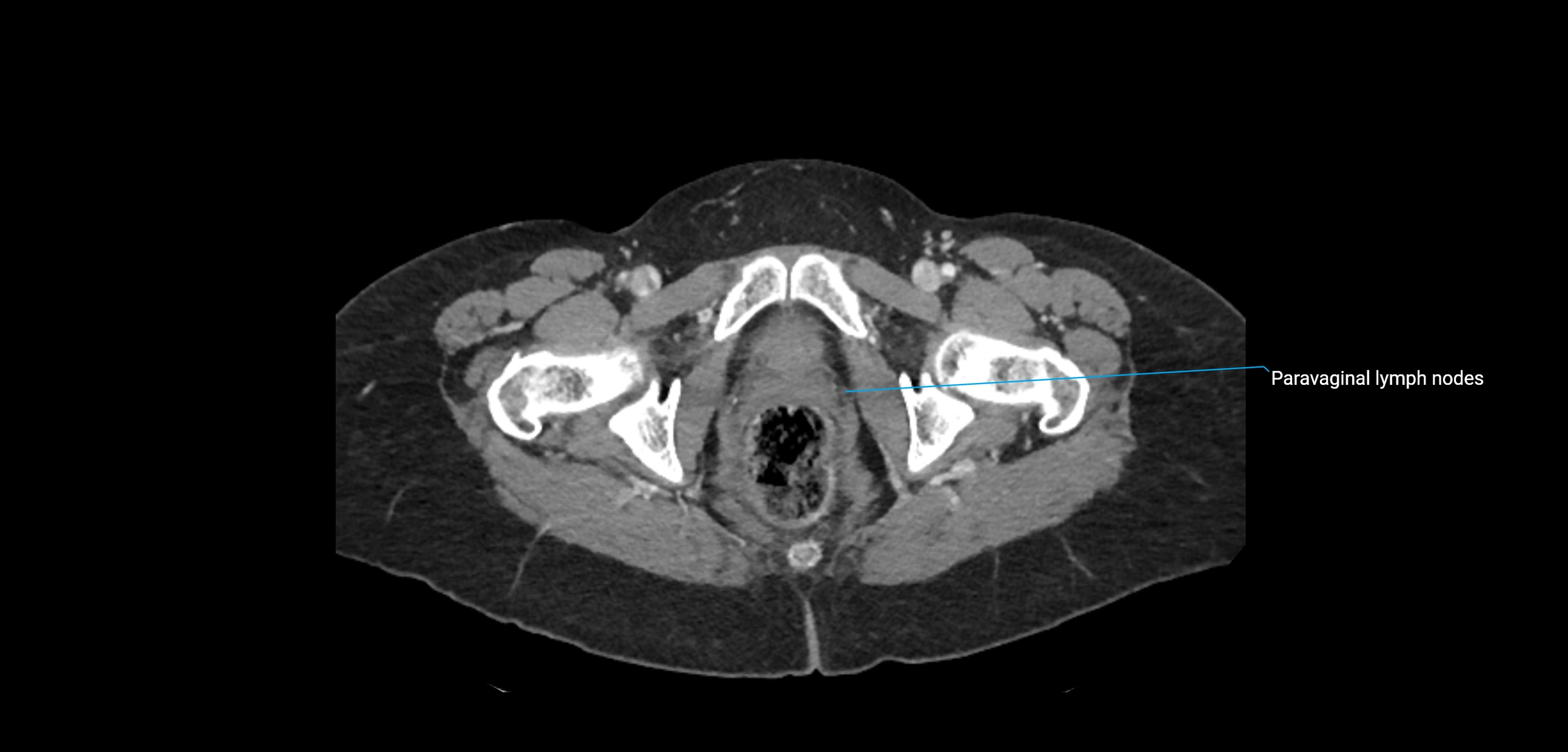 CT ct abdominal lymph nodes  axial cross sectional anatomy  enchanced radiology image -img-00002-00411.webp